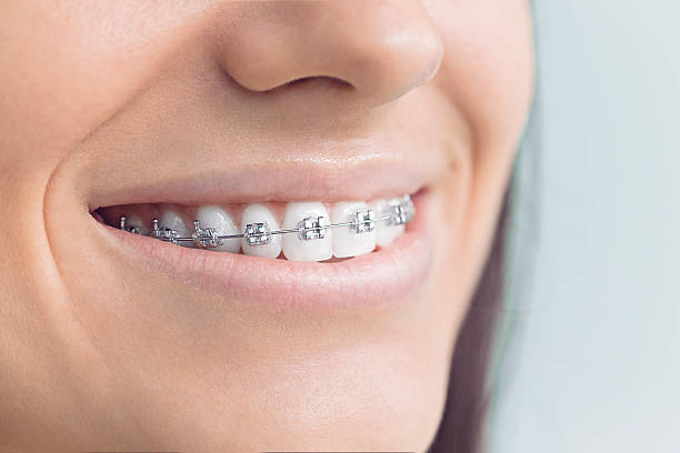 Dental Inlays and Onlays in Sebewaing, MI